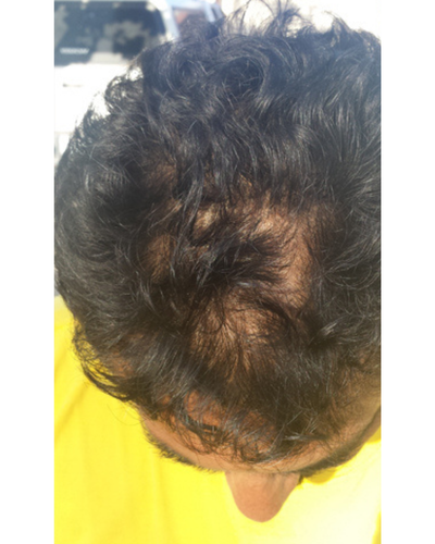 Before using Semis Shampoo